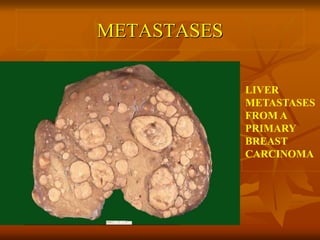 METASTASES
LIVER
METASTASES
FROM A
PRIMARY
BREAST
CARCINOMA
 