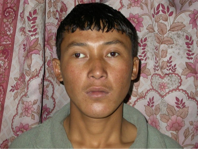 paralytic strabismus