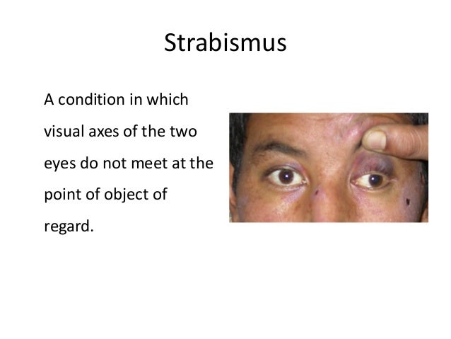 paralytic strabismus