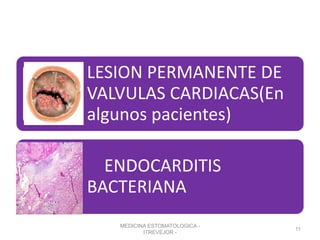 LESION PERMANENTE DE
VALVULAS CARDIACAS(En
algunos pacientes)
ENDOCARDITIS
BACTERIANA
MEDICINA ESTOMATOLOGICA -
ITREVEJOR -
11
 