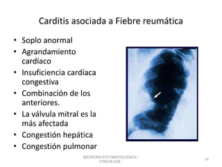 Carditis asociada a Fiebre reumática
• Soplo anormal
• Agrandamiento
cardíaco
• Insuficiencia cardíaca
congestiva
• Combinación de los
anteriores.
• La válvula mitral es la
más afectada
• Congestión hepática
• Congestión pulmonar
MEDICINA ESTOMATOLOGICA -
ITREVEJOR -
14
 