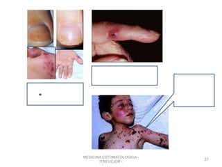 MEDICINA ESTOMATOLOGICA -
ITREVEJOR -
27
Nódulos de
Osler
Lesión de Janeway
Petequias
 