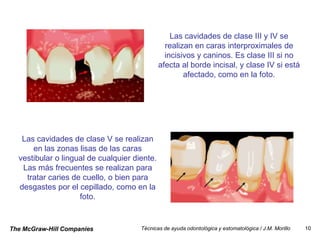 Las cavidades de clase III y IV se
                                                realizan en caras interproximales de
                                                incisivos y caninos. Es clase III si no
                                              afecta al borde incisal, y clase IV si está
                                                      afectado, como en la foto.




   Las cavidades de clase V se realizan
      en las zonas lisas de las caras
  vestibular o lingual de cualquier diente.
   Las más frecuentes se realizan para
    tratar caries de cuello, o bien para
  desgastes por el cepillado, como en la
                    foto.


The McGraw-Hill Companies             Técnicas de ayuda odontológica y estomatológica / J.M. Morillo   10
 
