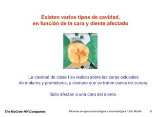 Existen varios tipos de cavidad,
                 en función de la cara y diente afectado




            La cavidad de clase I se realiza sobre las caras oclusales
        de molares y premolares, y siempre que se traten caries de surcos.

                            Solo afectan a una cara del diente.


The McGraw-Hill Companies            Técnicas de ayuda odontológica y estomatológica / J.M. Morillo   8
 