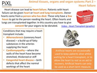 Animal tissues, organs and organ systems Part 2 –
Heart failure
Heart disease can lead to heart failure. Patients with heart
failure can be given heart or heart and lung transplants. Donor
hearts come from a person who has died. These only have a few
hours to get to the person needing the heart. Often hearts and
lungs are transplanted together. In this country you have to give
consent for your organs to be donated. Video - Heart Transplant (graphic)
Conditions that may require a heart
transplant include:
• Atherosclerosis (coronary heart
disease) – a build-up of fatty
substances in the arteries
supplying the heart
• Cardiomyopathy – where the
walls of the heart have become
stretched, thickened or stiff
• Congenital heart disease – birth
defects that affect the normal
workings of the heart
Artificial hearts are occasionally
used to keep patients alive whilst
waiting for a heart transplant, or to
allow the heart to rest as an aid to
recovery. Artificial hearts can only
be used as a short term measure.
 