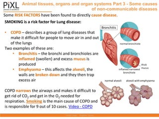 Some RISK FACTORS have been found to directly cause disease.
Animal tissues, organs and organ systems Part 3 - Some causes
of non-communicable diseases
SMOKING is a risk factor for Lung disease:
• COPD – describes a group of lung diseases that
make it difficult for people to move air in and out
of the lungs
Two examples of these are:
• Bronchitis – the bronchi and bronchioles are
inflamed (swollen) and excess mucus is
produced
• Emphysema – this affects the alveoli, the
walls are broken down and they then trap
excess air
COPD narrows the airways and makes it difficult to
get rid of CO2 and get in the O2 needed for
respiration. Smoking is the main cause of COPD and
is responsible for 9 out of 10 cases. Video - COPD
normal bronchiole
inflamed narrowed
bronchiole
thick
mucus
Bronchitis
normal alveoli alveoli with emphysema
 