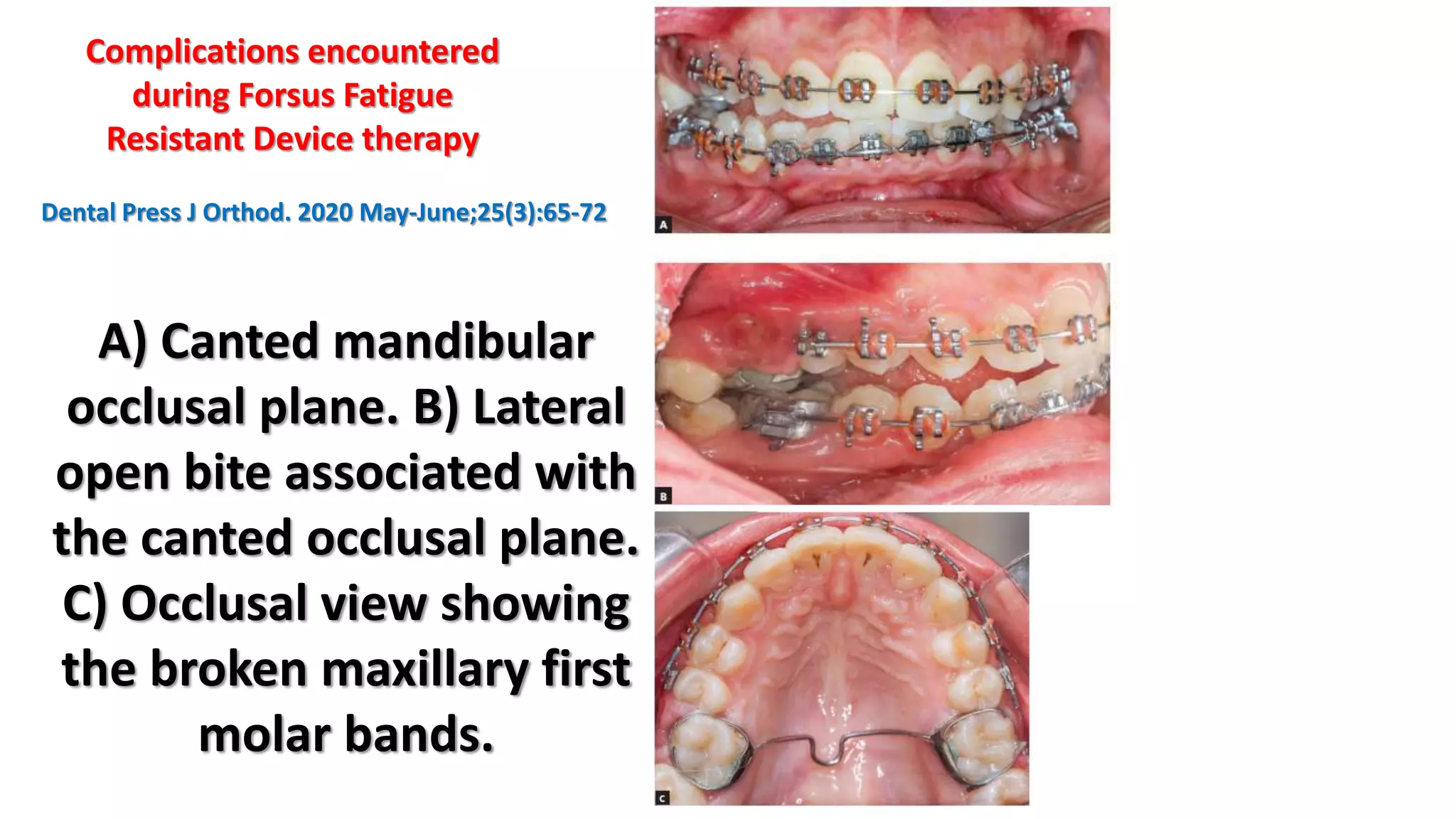 orthodontic correction of canted occlusal plane part 2 PPT