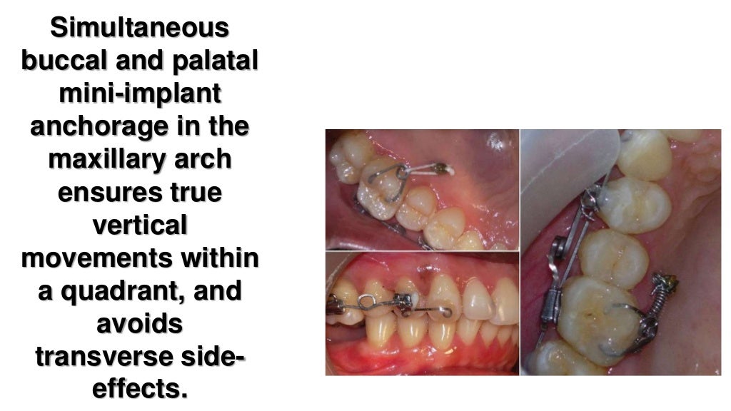 orthodontic correction of canted occlusal plane part 2