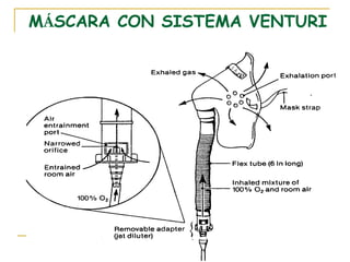 MÁSCARA CON SISTEMA VENTURI
 