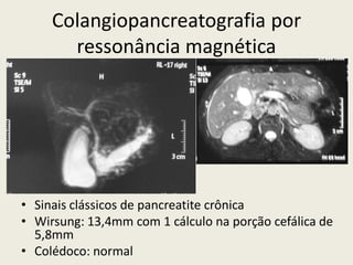 Colangiopancreatografia por
       ressonância magnética




• Sinais clássicos de pancreatite crônica
• Wirsung: 13,4mm com 1 cálculo na porção cefálica de
  5,8mm
• Colédoco: normal
 
