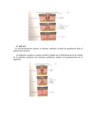  DIA 4-5.
La neovascularizacion alcanza su máximo conforme el tejido de granulación llena el
espacio de la incisión.
La epidermis recupera su espesor normal a medida que la diferenciación de las células
de la superficie producen una estructura epidérmica madura con queratinizacion en la
superficie.
 