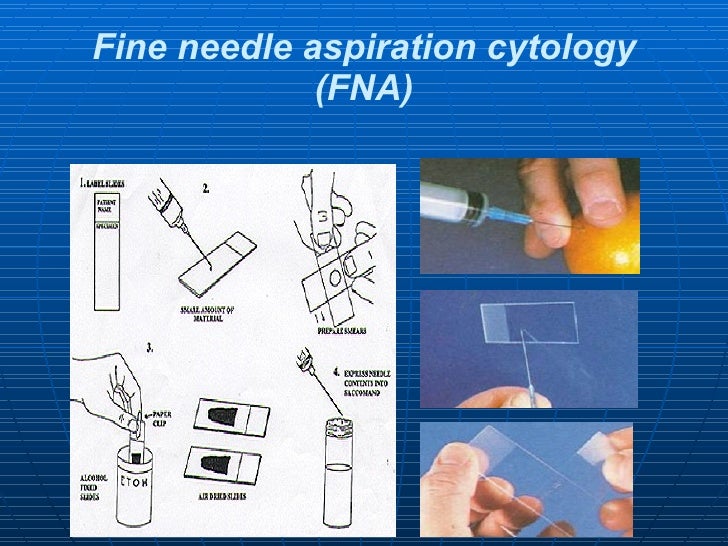 2 pathological diagnosis of cancer