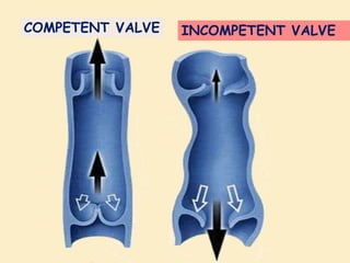 PATHOPHYSIOLOGY OF VARICOSE VEINS | PPTX