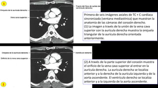 Patologia Rx Tc Rmn Semiologia Corazon Art Pulmonar Y Aorta PDF patologia-rx-tc-rmn-semiologia-corazon-art-pulmonar-y-aorta-pdf