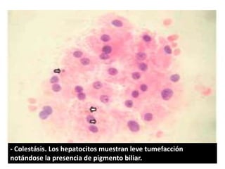 - Colestásis. Los hepatocitos muestran leve tumefacción
notándose la presencia de pigmento biliar.
 