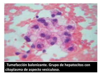 - Tumefacciónbalonizante. Grupo de hepatocitos con
citoplasma de aspecto vesiculoso.
 