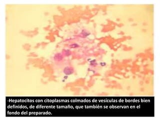 -Hepatocitos con citoplasmas colmados de vesículas de bordes bien
definidos, de diferente tamaño, que también se observan en el
fondo del preparado.
 