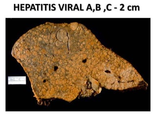 HEPATITIS VIRAL A,B ,C - 2 cm
 