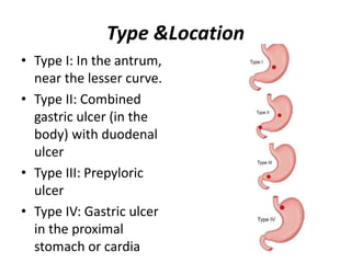 Type &Location
• Type I: In the antrum,
near the lesser curve.
• Type II: Combined
gastric ulcer (in the
body) with duodenal
ulcer
• Type III: Prepyloric
ulcer
• Type IV: Gastric ulcer
in the proximal
stomach or cardia
 