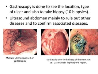 • Gastroscopy is done to see the location, type
of ulcer and also to take biopsy (10 biopsies).
• Ultrasound abdomen mainly to rule out other
diseases and to confirm associated diseases.
Multiple ulcers visualised on
gastroscopy
(A) Gastric ulcer in the body of the stomach;
(B) Gastric ulcer in prepyloric region.
 