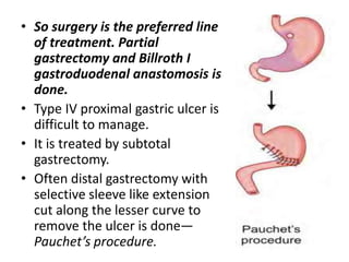 • So surgery is the preferred line
of treatment. Partial
gastrectomy and Billroth I
gastroduodenal anastomosis is
done.
• Type IV proximal gastric ulcer is
difficult to manage.
• It is treated by subtotal
gastrectomy.
• Often distal gastrectomy with
selective sleeve like extension
cut along the lesser curve to
remove the ulcer is done—
Pauchet’s procedure.
 