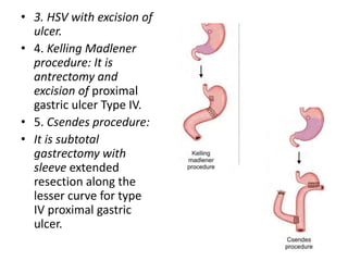 • 3. HSV with excision of
ulcer.
• 4. Kelling Madlener
procedure: It is
antrectomy and
excision of proximal
gastric ulcer Type IV.
• 5. Csendes procedure:
• It is subtotal
gastrectomy with
sleeve extended
resection along the
lesser curve for type
IV proximal gastric
ulcer.
 