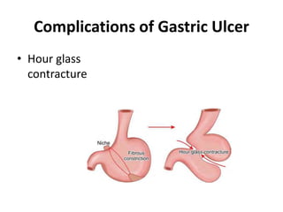 Complications of Gastric Ulcer
• Hour glass
contracture
 