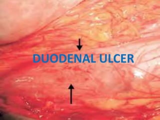 DUODENAL ULCER
 