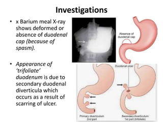 Investigations
• x Barium meal X-ray
shows deformed or
absence of duodenal
cap (because of
spasm).
• Appearance of
‘trifoliate’
duodenum is due to
secondary duodenal
diverticula which
occurs as a result of
scarring of ulcer.
 