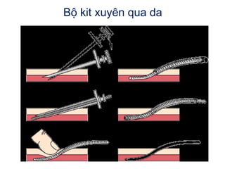 Bộ kit xuyên qua da
 