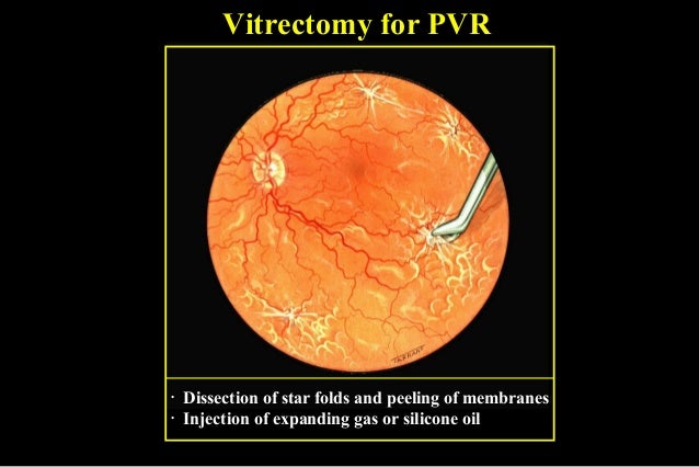 retina detachment surgery recovering retina detachment surgery recovering