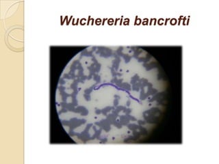 Wuchereria bancrofti
 