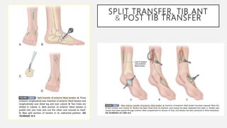 Tib Post Loading PostPolio Residual Paralysis part2 lower limb | PPTX