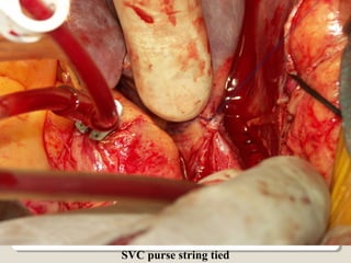 SVC purse string tied
 