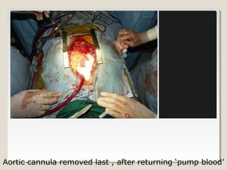 Aortic cannula removed last , after returning ‘pump blood’
 