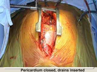 Pericardium closed, drains inserted
 