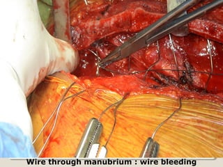 Wire through manubrium : wire bleeding
 