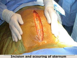 Incision and scouring of sternum
 