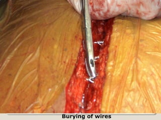 Burying of wires
 