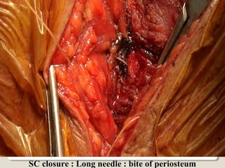 SC closure : Long needle : bite of periosteum
 