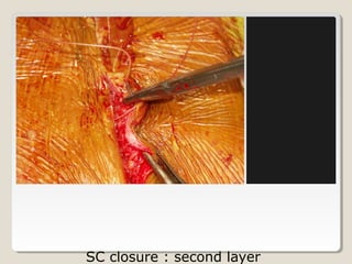 SC closure : second layer
 