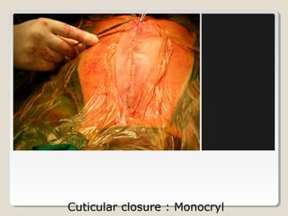 Cuticular closure : Monocryl
 