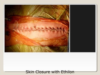 Skin Closure with Ethilon
 