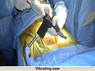 Vibrating saw
 