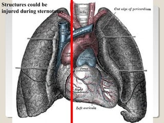 Structures could be
injured during sternotomy
 
