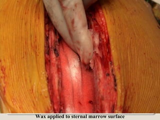 Wax applied to sternal marrow surface
 