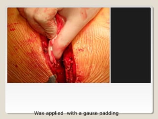 Wax applied with a gause padding
 