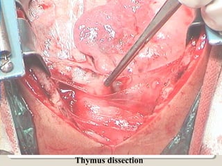 Thymus dissection
 