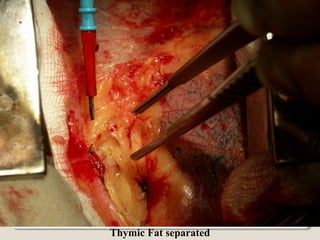 Thymic Fat separated
 