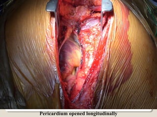 Pericardium opened longitudinally
 